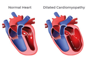 Cardiomyopathy Treatment | Dr. Benny Jose